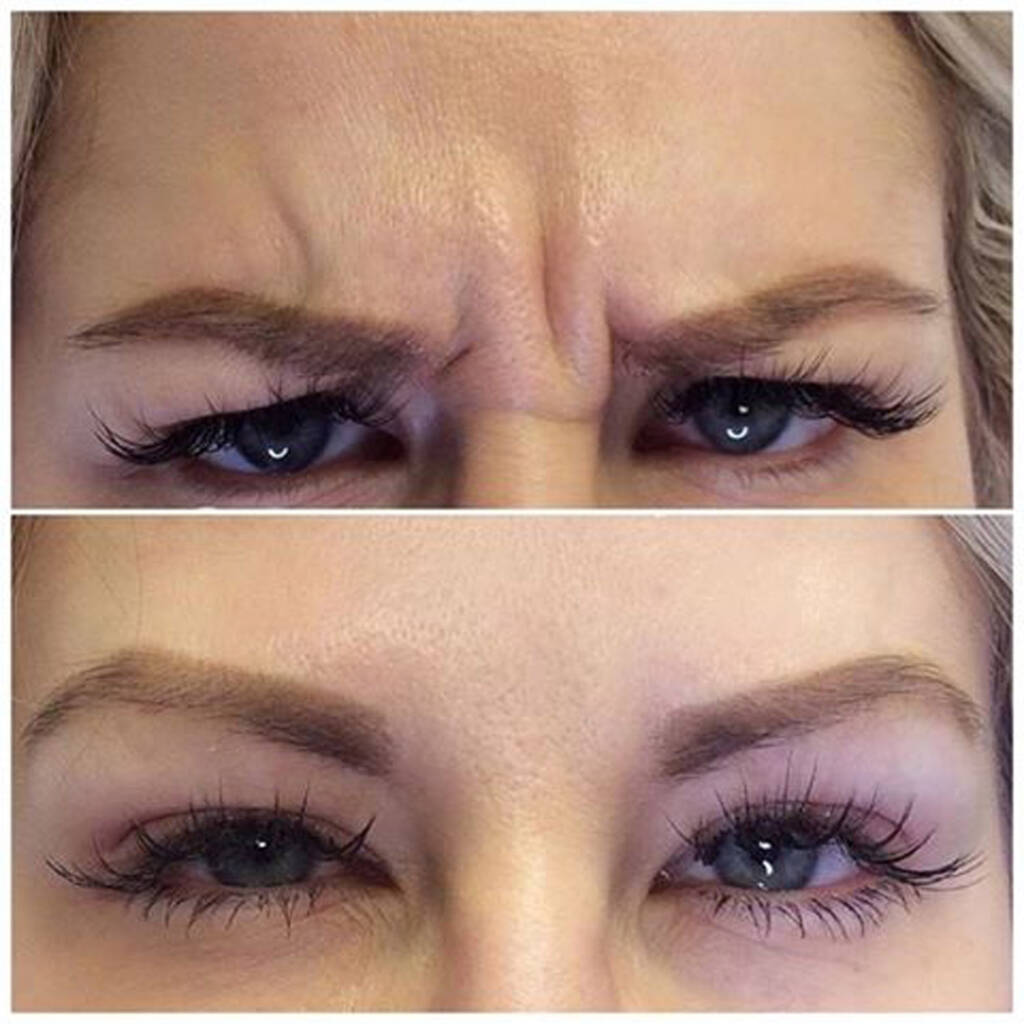 botoks na czoło przed i po tesoro clinic