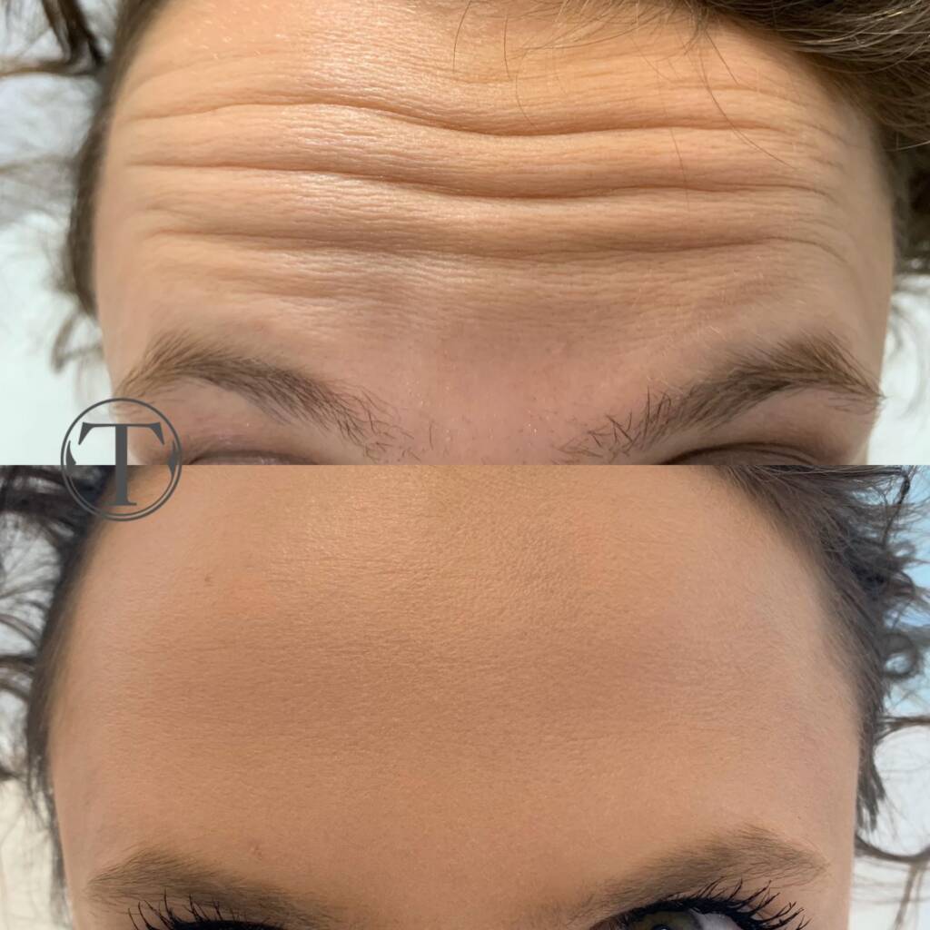 zmarszczki botox wrocław