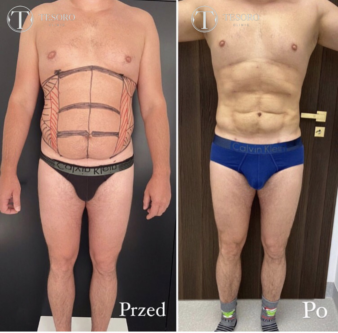 Efekty liposukcji brzucha