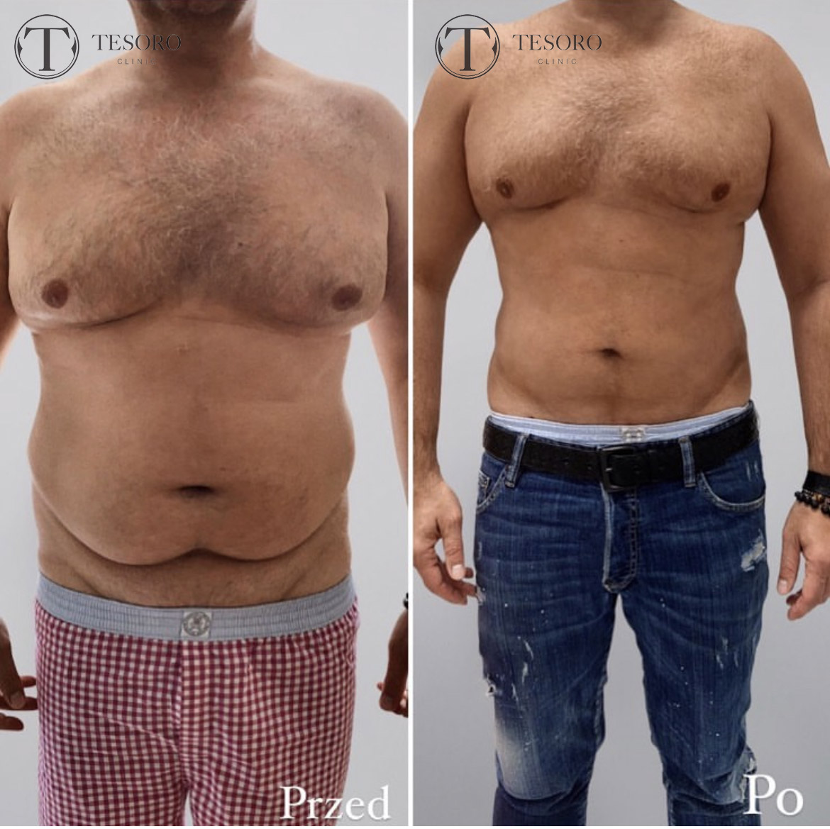 Efekty zabiegu liporzeźbienia ciała