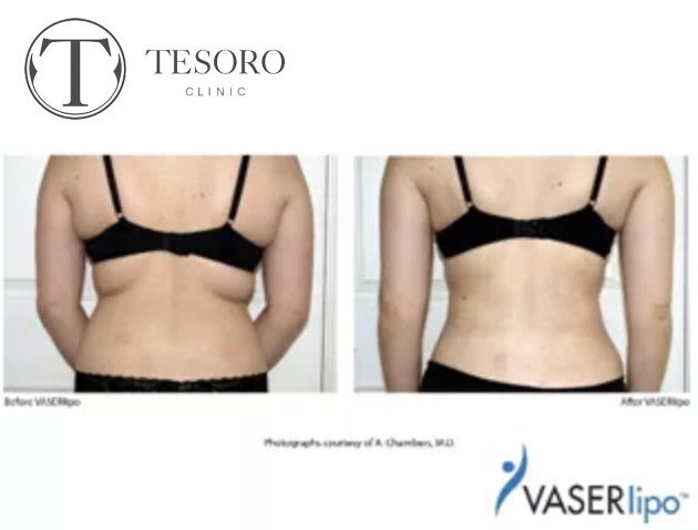 Liposukcja pleców Vaser Lipo