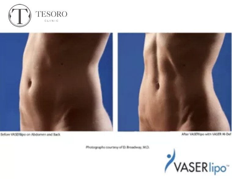 Liposukcja ultradźwiękowa brzucha