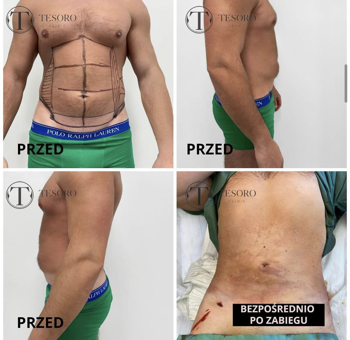 Liposukcja Vaser Lipo brzucha