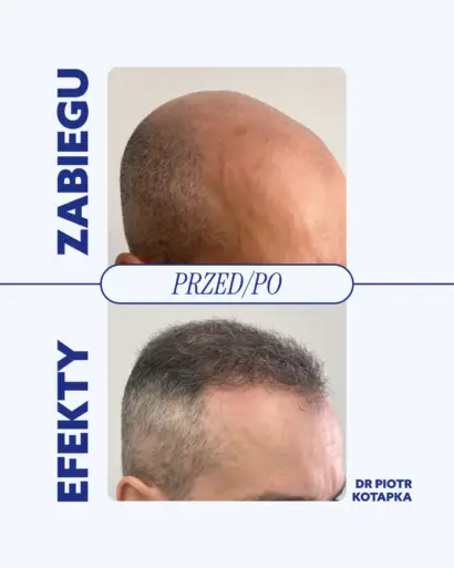przeszczep-włosów-wrocław