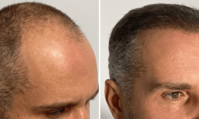 przeszczep-wlosow-fue-wroclaw