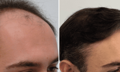 przeszczep-wlosow-metoda-fue