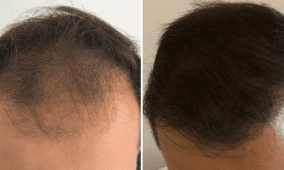 transplantacja-wlosow-fue