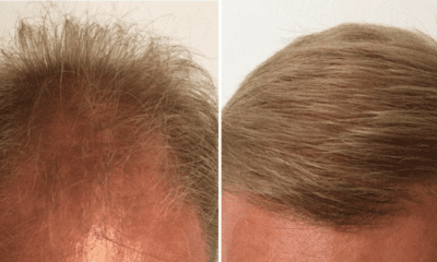 geste-wlosy-po-przeszczepie-fue