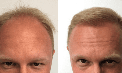 przeszczep-efekty-wlosy