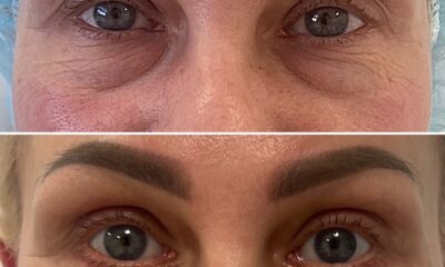 laserowa korekcja powiek