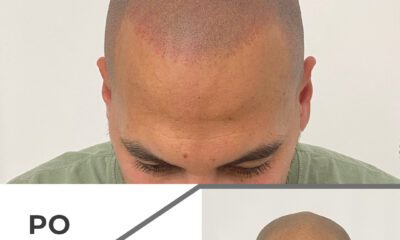 Mikropigmentacja skóry głowy wrocław - 1