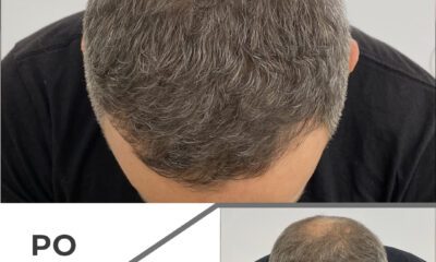 Mikropigmentacja skóry głowy wrocław - 2