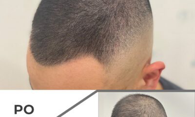 Mikropigmentacja skóry głowy wrocław - 3