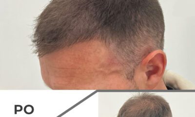 Mikropigmentacja skóry głowy wrocław - 4