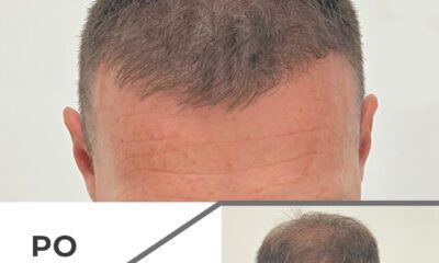 Mikropigmentacja skóry głowy wrocław - 5