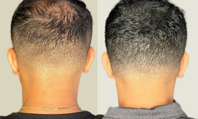 Mikropigmentacja skóry głowy wrocław - 6