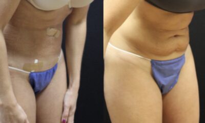 Renuvion J plasma wroclaw efekty4