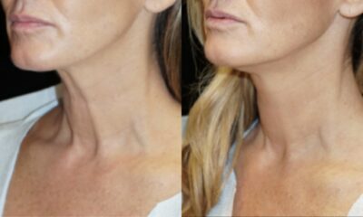 Renuvion J plasma wroclaw efekty6