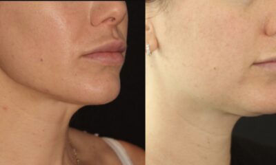 Renuvion J plasma wroclaw efekty7