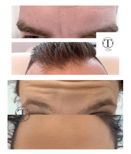 botoks na czoło w klinice Tesoro Clinic we Wrocławiu