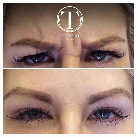 botoks na czoło przed i po