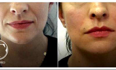 bruzdy-nosowo-wargowe--wypeąnienie2