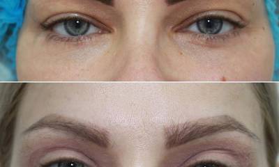 chirurgiczna korekcja powiek