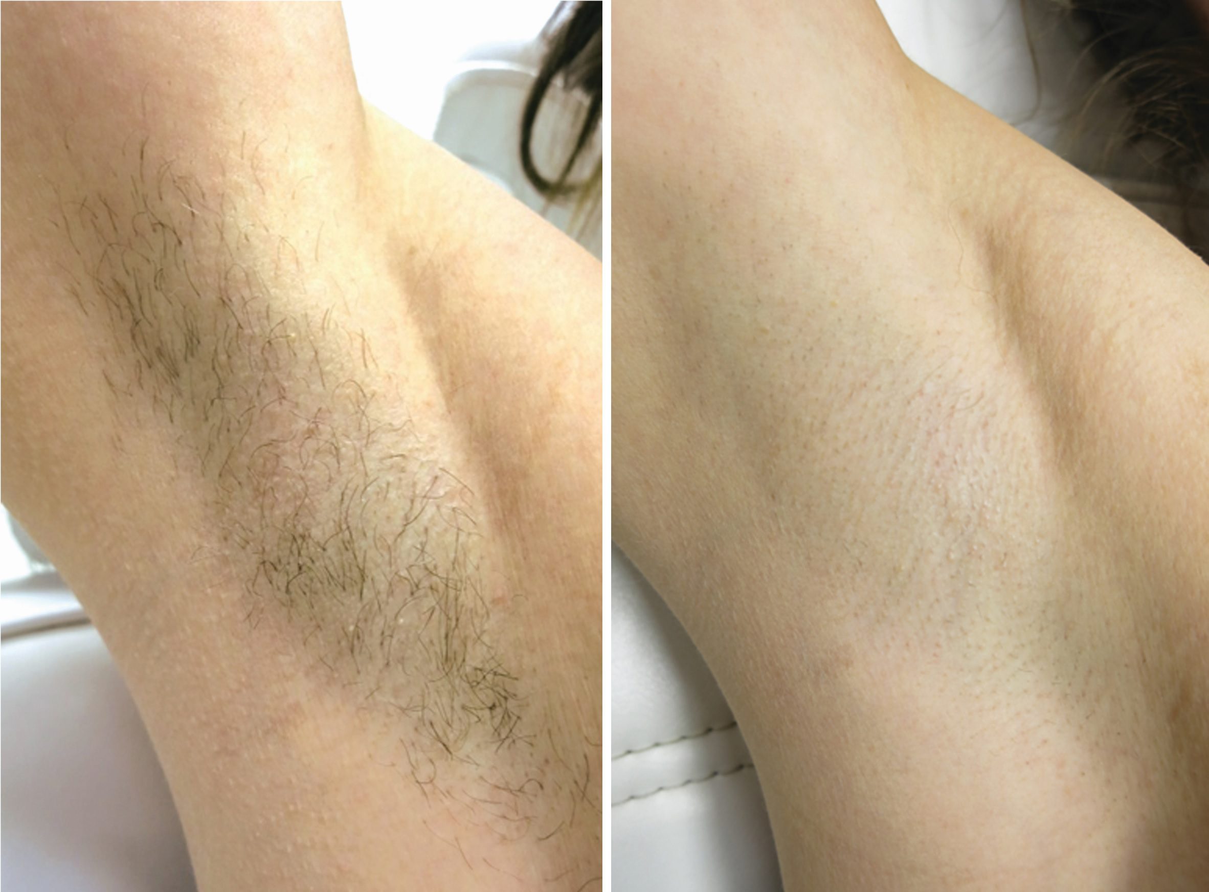 depilacja laserowa ile trwa efekt