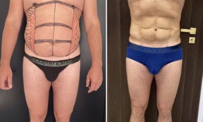 efekty-liposukcji-brzucha-Vaser-Lipo-4D