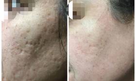 laser frakcyjny efekty przed i po zabiegu w Tesoro Clinic