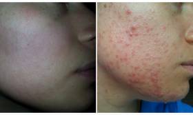 laserowe usuwanie blizn potrądzikowych laserem frakcyjnym