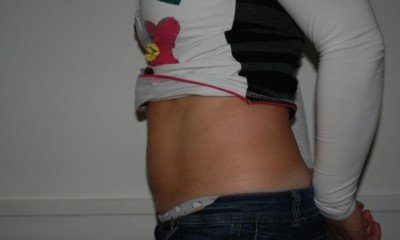 kriolipoliza cooltech efekty po zabiegu