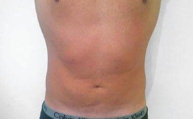 kriolipoliza wrocław po zabiegu