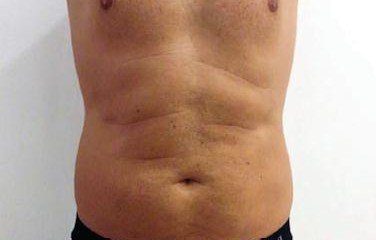 kriolipoliza cooltech przed zabiegiem