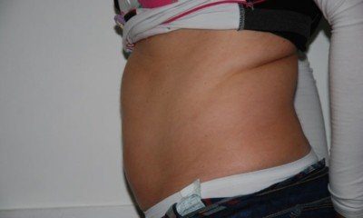 kriolipoliza cooltech wrocław przed zabiegiem