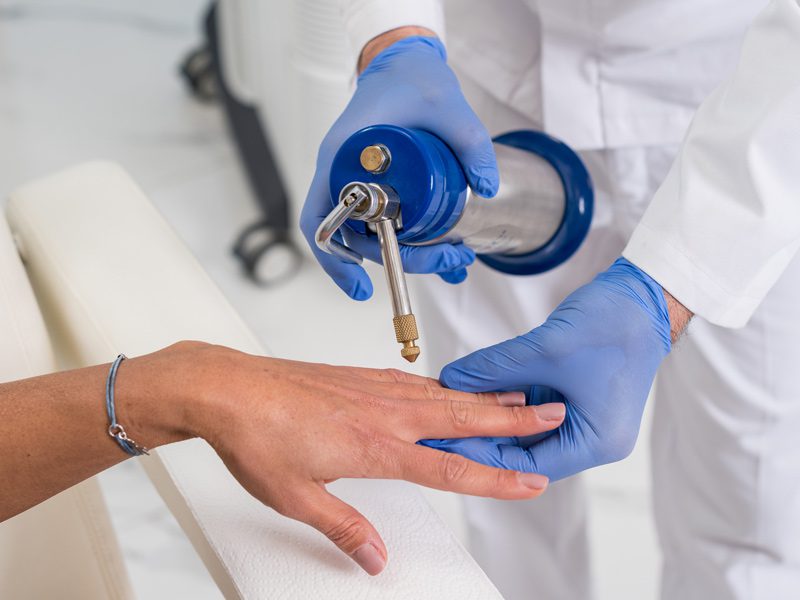 laserowe usuwanie kurzajek alternatywa dla wymrażania