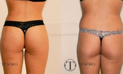 ksztaltowanie-posladkow-lipomodelling