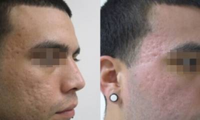 laser-frakcyjny-5-mu5fgynbff2vaqohozhcxaxvxhf6who8m6903bil2k