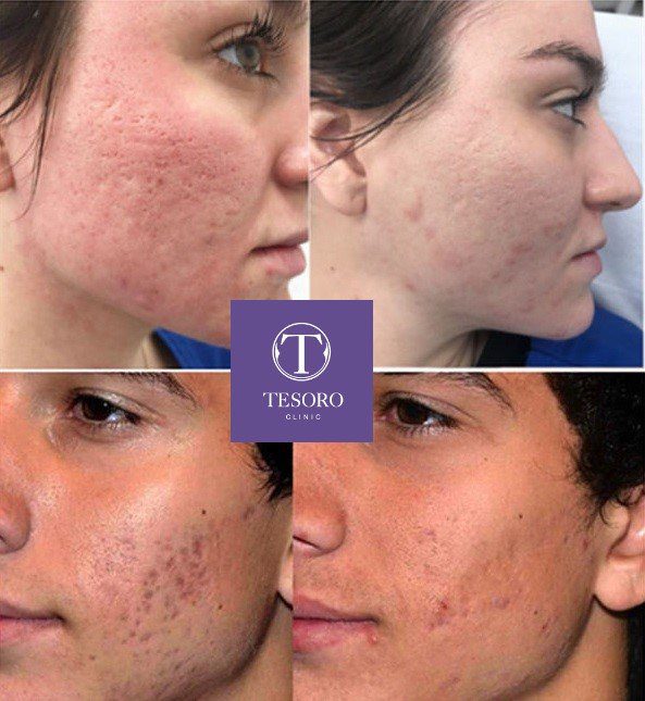 jak działa laser frakcyjny