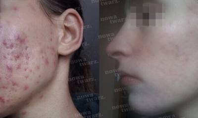 laserfrakcyjny_04a-mu5b6oezndvjmwsblsmv5qj5rnvah06bqjcvba9wdo