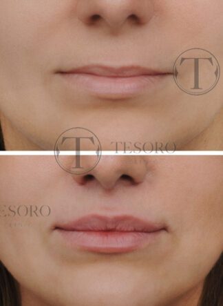 Lip lift, lifting ust