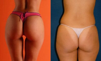 lipomodelling-posladkow-tesoro-clinic