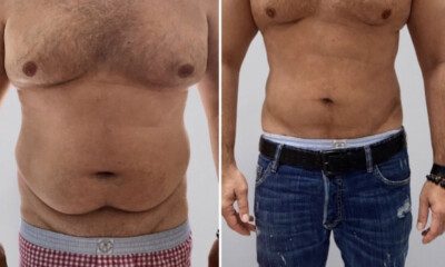 liporzezbienie-ciała-vaser-lipo-4d