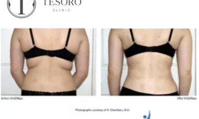 liposukcja-plecow-vaser-lipo