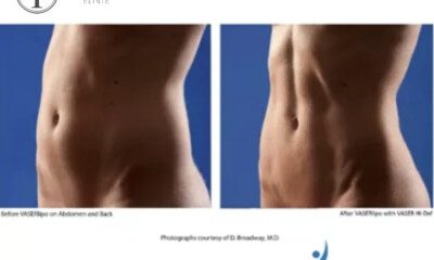 liposukcja-ultradzwiekowa-brzucha-vaser-lipo