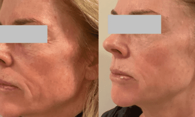 naturalny-lifting-kwas-polimlekowy