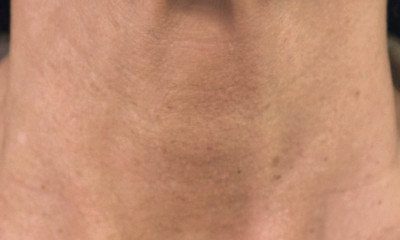 piersini_szyja_po_profhilo