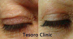 plasma iq na powieki Wrocław Tesoro Clinic