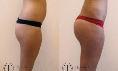 powiekszanie-posladkow-wlasnym-tluszczem