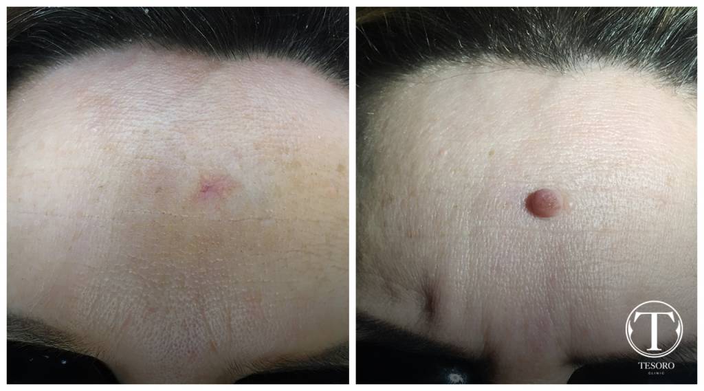 jak usunąć pieprzyk